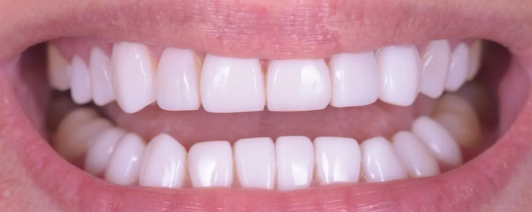 composite resin veneers after procedure