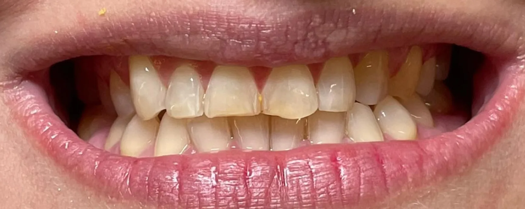 patient before composite resin veneers