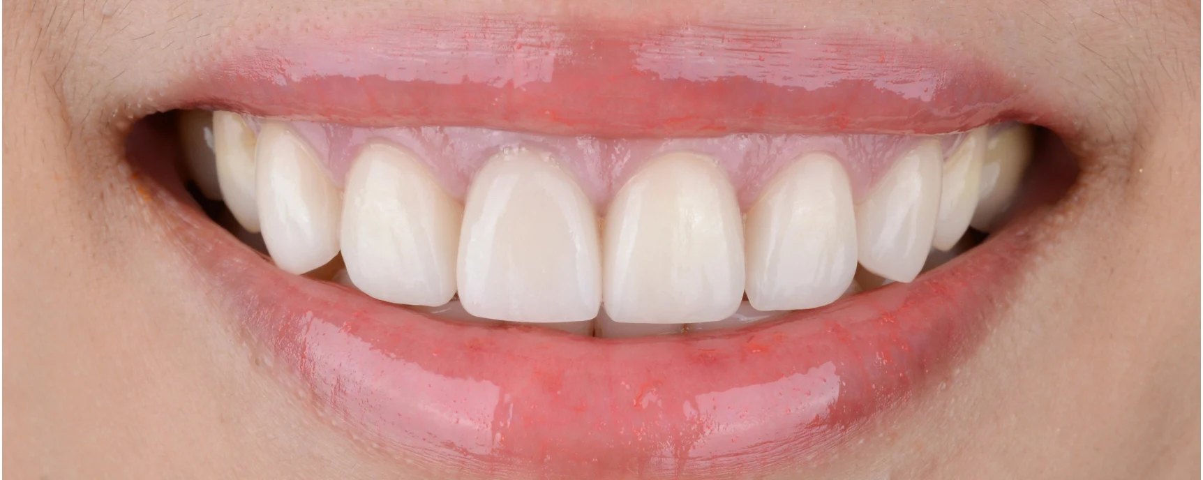 teeth-whitening-after